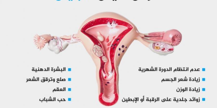 على أي عمر تظهر متلازمة تكيس المبايض؟ - زاجل الإخباري