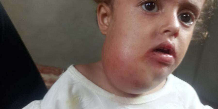 ورم في رقبتها وصعوبة بالنطق.. عجز المنظومة الصحية بغزة يهدد حياة الطفلة جوليا - زاجل الإخباري