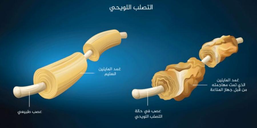 الكوابح البروتينية مفتاح لحل معضلة التصلب المتعدد - زاجل الإخباري